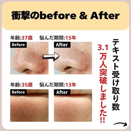 あなたの肌に合ったスキンケア💐コーくん先生 on LIPS 「【知らないとマジで損です】角栓を一撃で消す裏技はコレ🤫..あな..」(7枚目)