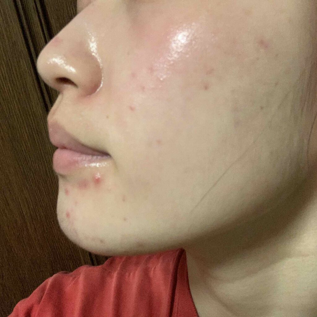 うーたんたんめん🍜 on LIPS 「こんばんは!うーたんたんめんです🍜今回はアダパレン(ディフェイ..」(2枚目)