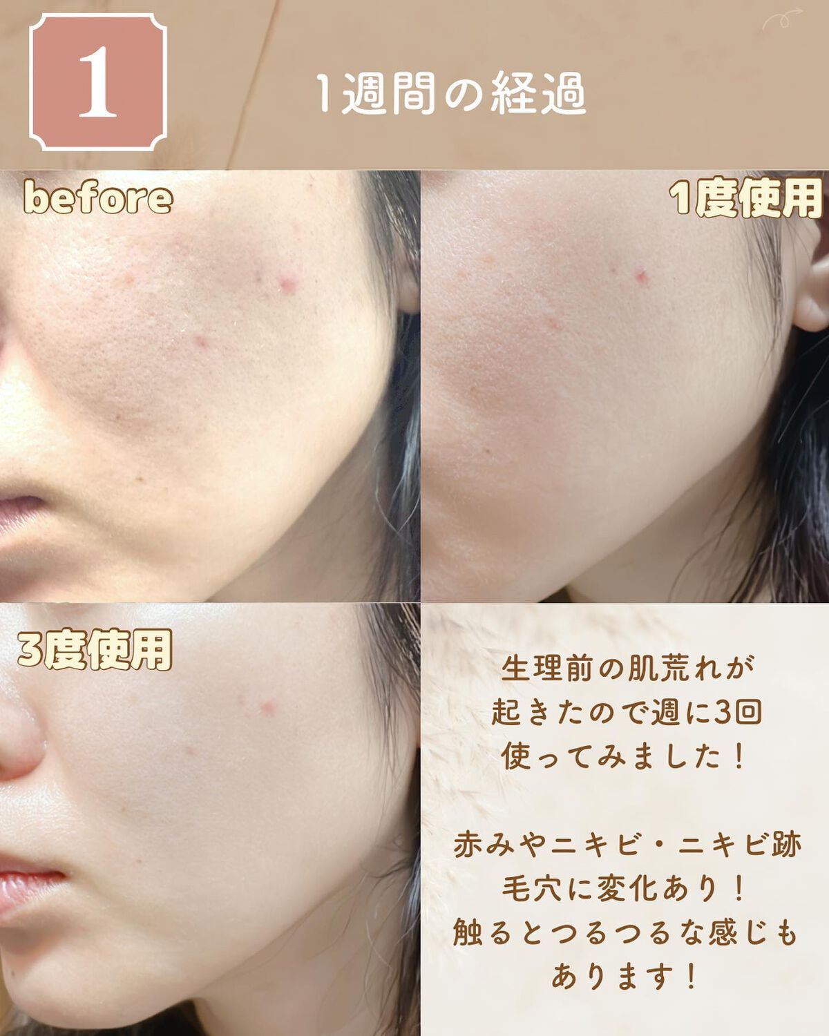 AZアゼライン酸10セラム/コスデバハ/美容液を使ったクチコミ(3枚目)