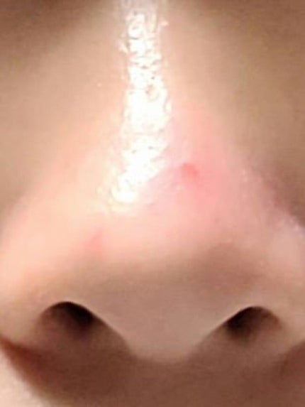 syu/朱 on LIPS 「助けてくださいお願いします<(__)>ニキビができてしまいまし..」(2枚目)