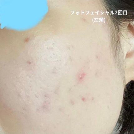 K on LIPS 「12/23~2/1までの経過12/23~1/10べピオゲル1/..」(5枚目)