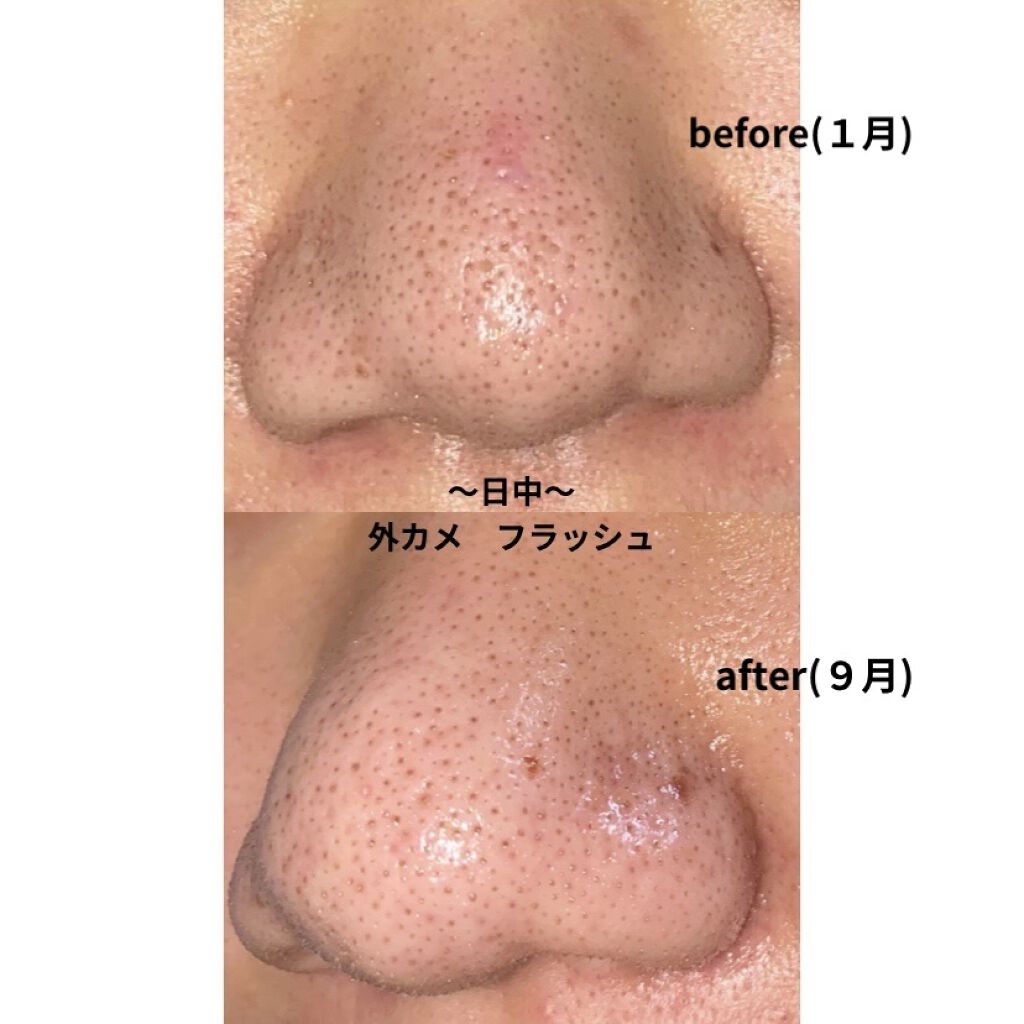 薬用 しみ 集中対策 美容液/メラノCC/美容液を使ったクチコミ（2枚目）