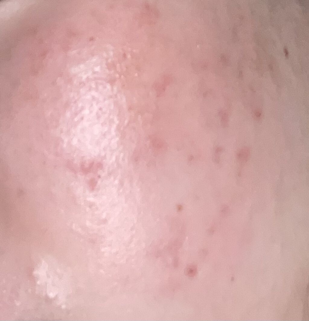 デュアック配合ゲル/美容皮膚科/フェイスクリームを使ったクチコミ（1枚目）