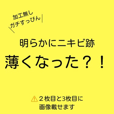 覚えてますか？？

以前、
ちふれさんの#ボラージクリーム
を、ニキビケアとして紹介したのですが…

なんと！！

１ヶ月ちょっとで、こんなにニキビ跡が薄くなったんです！！

🌟やってたこと
1．お風呂