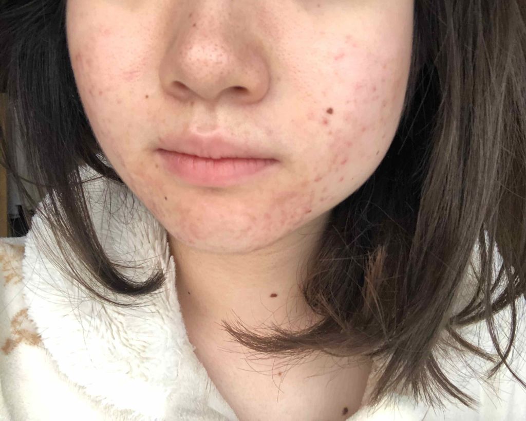 マンスリースキンケアプログラム(旧)/APEX/スキンケアキットを使ったクチコミ(2枚目)