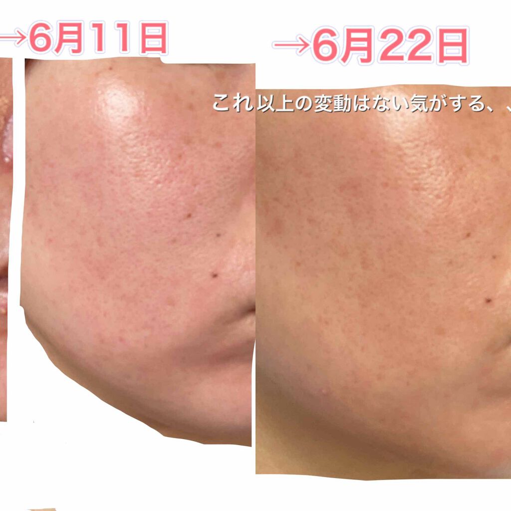 ベピオゲル/マルホ株式会社/その他を使ったクチコミ（2枚目）