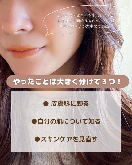 enuko | 美容オタク on LIPS 「【実は1年前までニキビ肌でした🤫】もともとニキビはできやすかっ..」(5枚目)