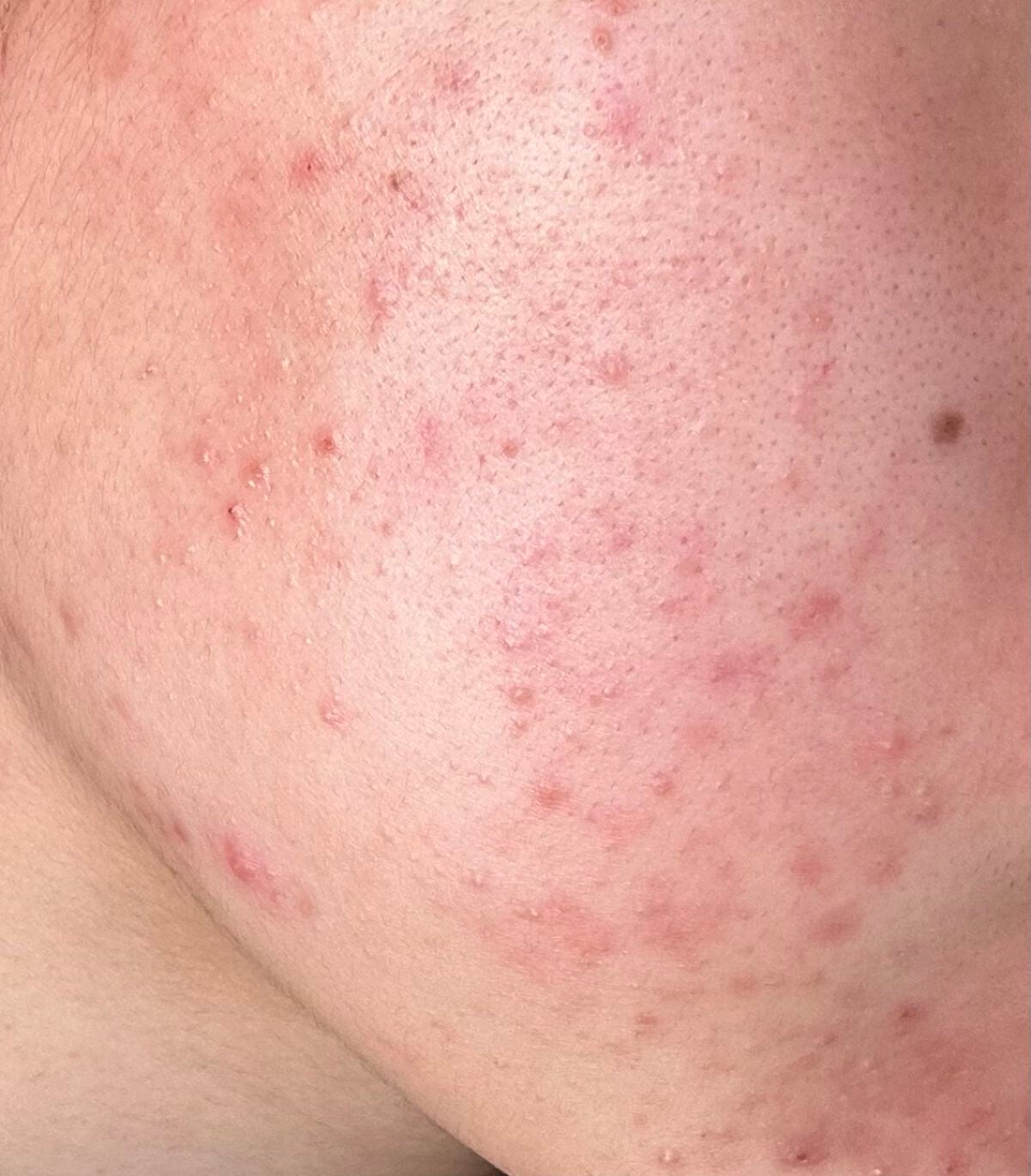 スキンピールバー ティートゥリー/サンソリット/洗顔石鹸を使ったクチコミ(3枚目)