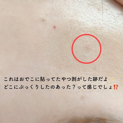 リリーのママ on LIPS 「💜DAEWOONG💜〈デウン製薬〉〜EasyDERM〜Easy..」(5枚目)