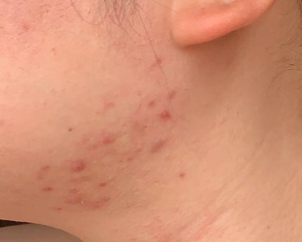 あさみん on LIPS 「10年くらい共にした愛らしさのかけらもないニキビ軍団⚡️環境が..」(4枚目)