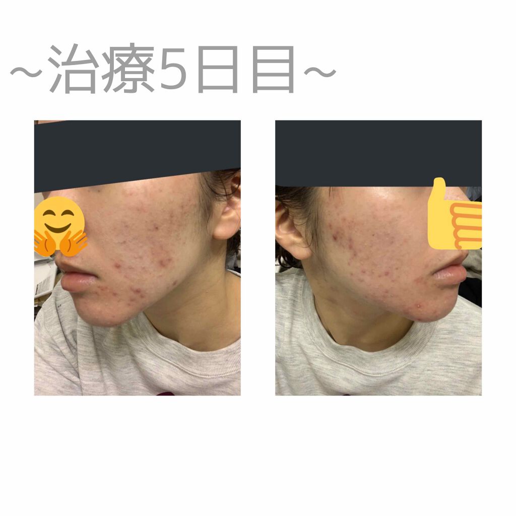 ビーソフテン ローション(医薬品)/持田製薬/その他を使ったクチコミ（3枚目）