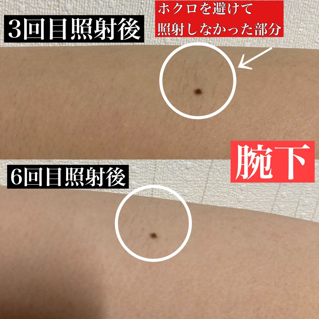 光美容器 光エステ ボディ&フェイス用 ハイパワー ゴールドES 光美容器 光エステ ボディ&フェイス用 ハイパワー ゴールドES