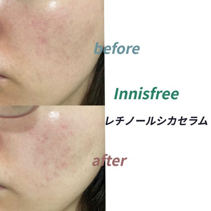 レチノール シカ リペア セラム/innisfree/美容液を使ったクチコミ(2枚目)