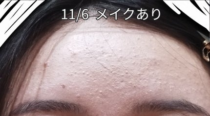 ノブ A アクネソープ/NOV/洗顔石鹸を使ったクチコミ(3枚目)