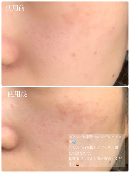 ブラックシュガー パーフェクト エッセンシャル スクラブ2X/SKINFOOD/洗い流すパック・マスクを使ったクチコミ(3枚目)