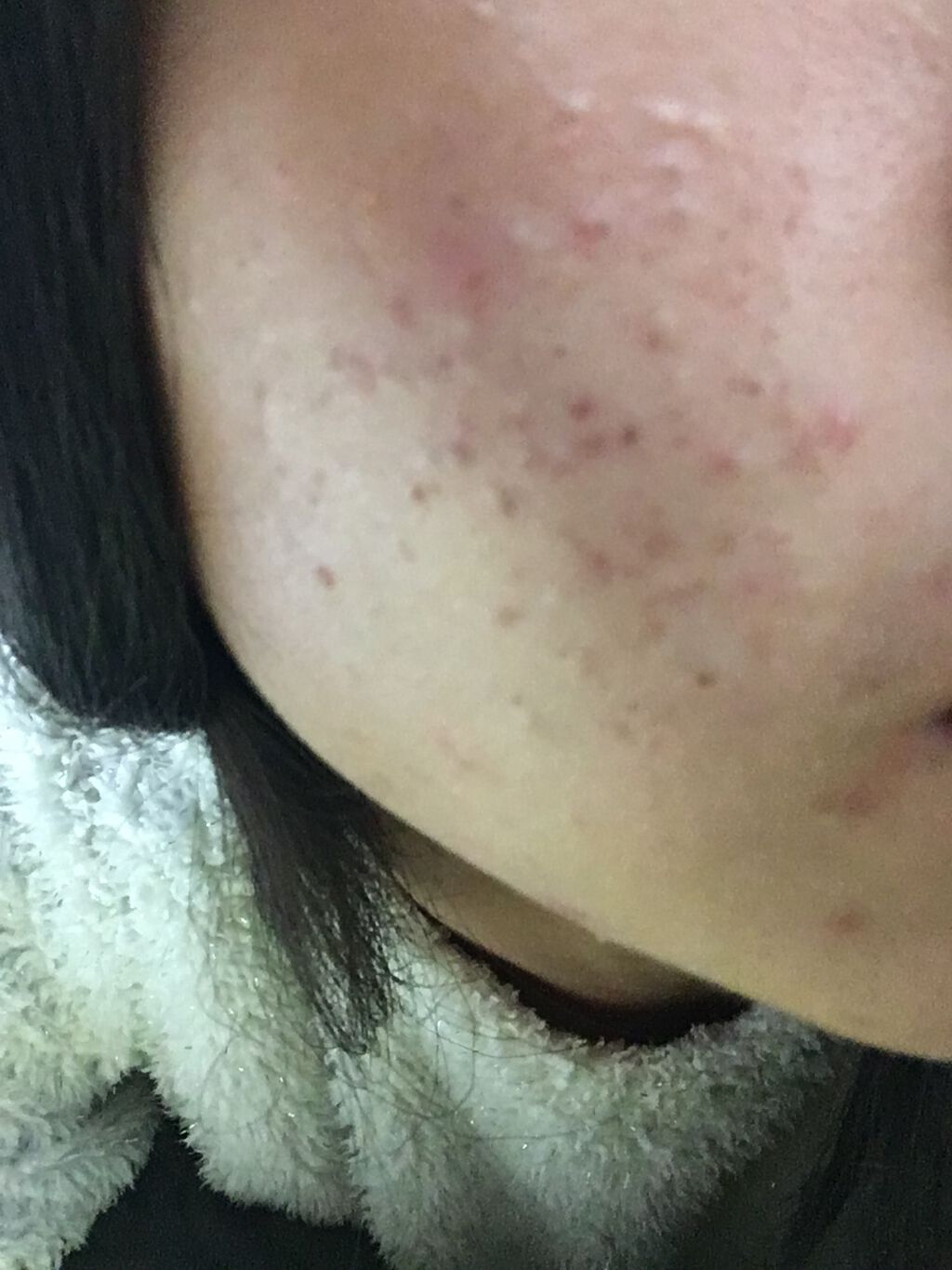 ペアアクネクリームW(医薬品)/ペア/その他を使ったクチコミ(2枚目)