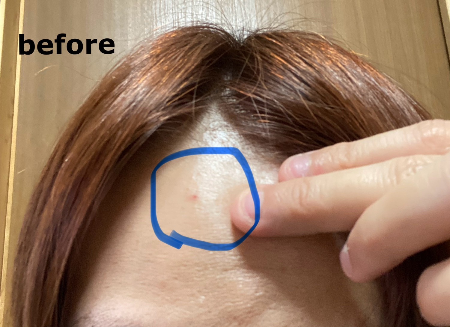 クリアパッチ/Angelab/にきびパッチを使ったクチコミ（3枚目）