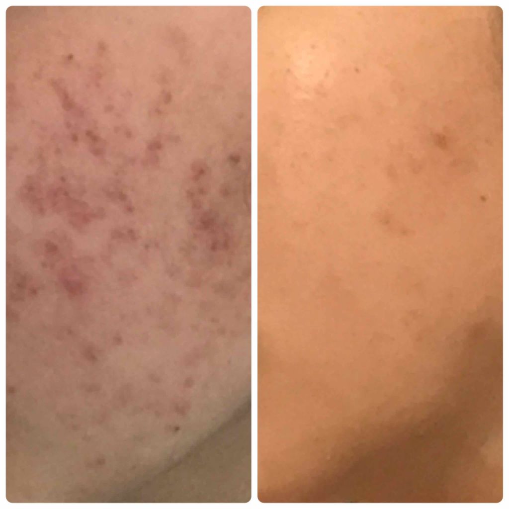 ミノン アミノモイスト 薬用アクネケア ミルク/ミノン/乳液を使ったクチコミ（3枚目）