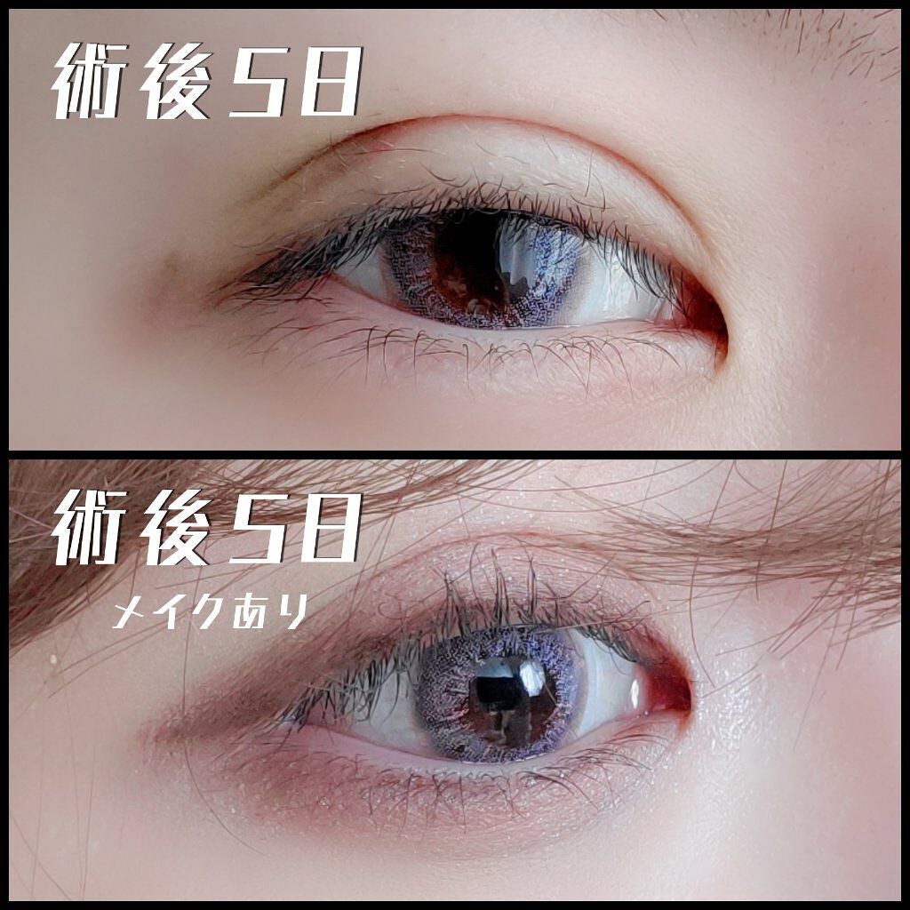 m. on LIPS 「埋没で二重になった話🦋/こんにちは𓆈今回は1か月前に埋没を行い..」(5枚目)