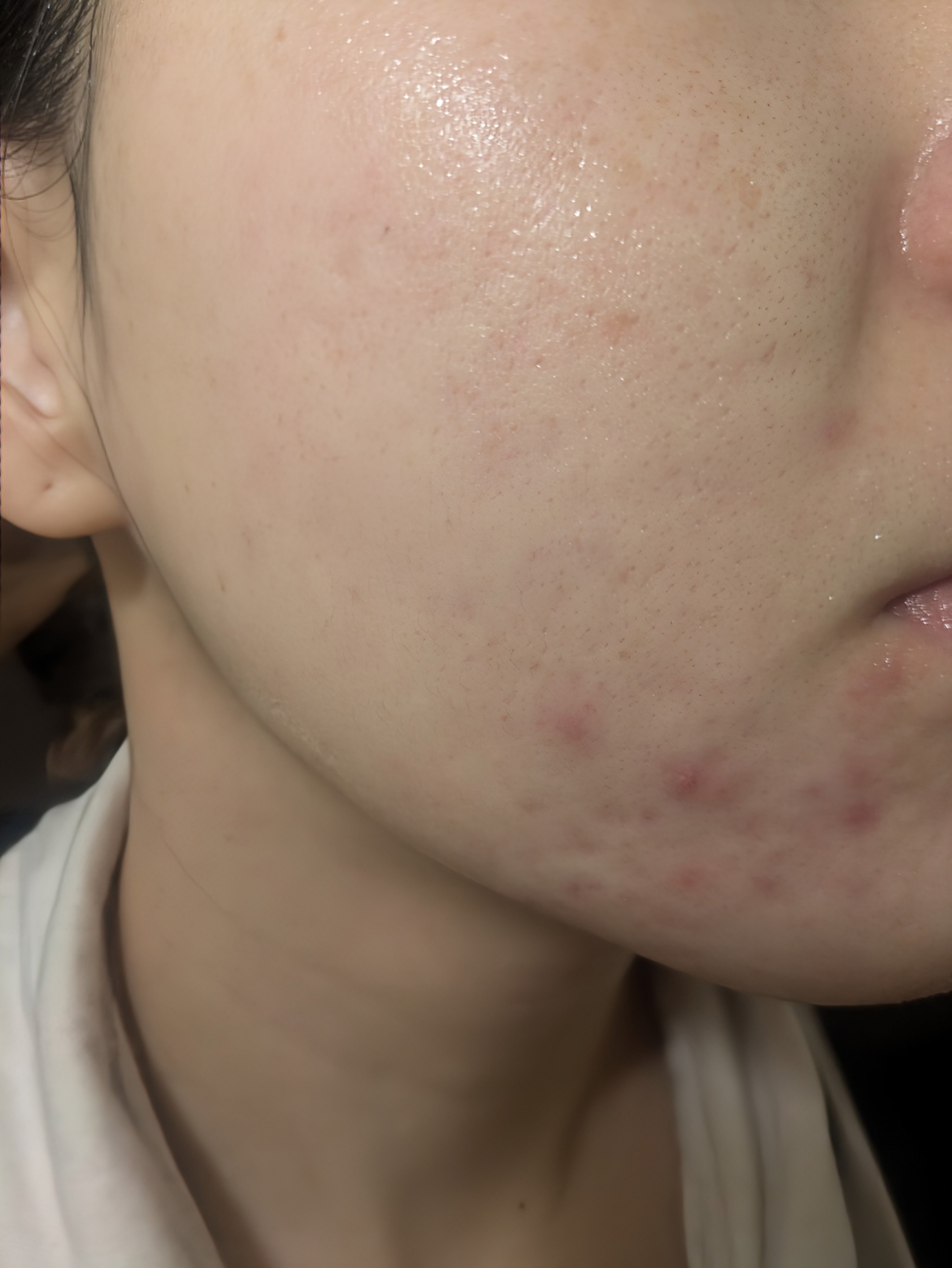 11/10の#汚肌工事録

黄色く膿んでしまいました😢
思い返すと、ものすごく乾燥していたのに、メイクを優先してしまいました。