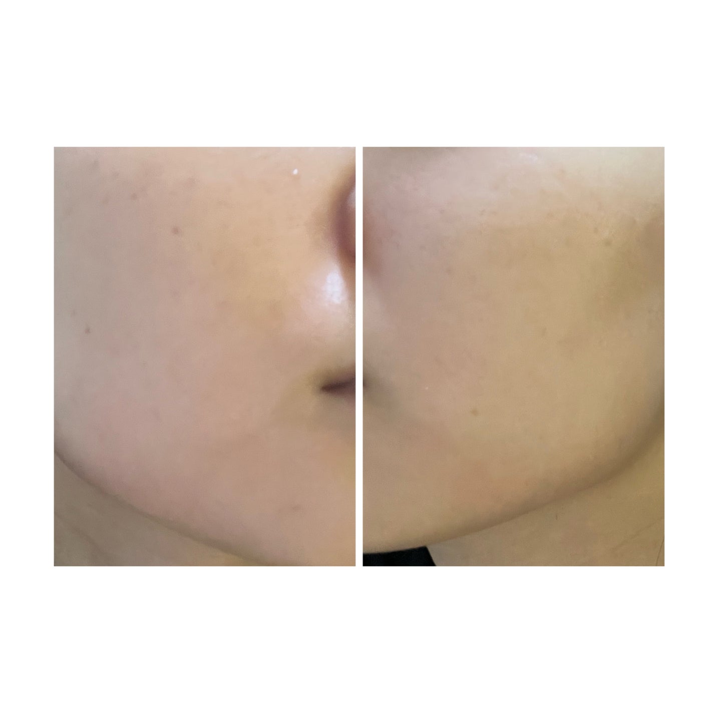 ぽむ on LIPS 「2023.9.13皮膚科に受診 エピデュオとヘパリン処方1枚目..」(5枚目)