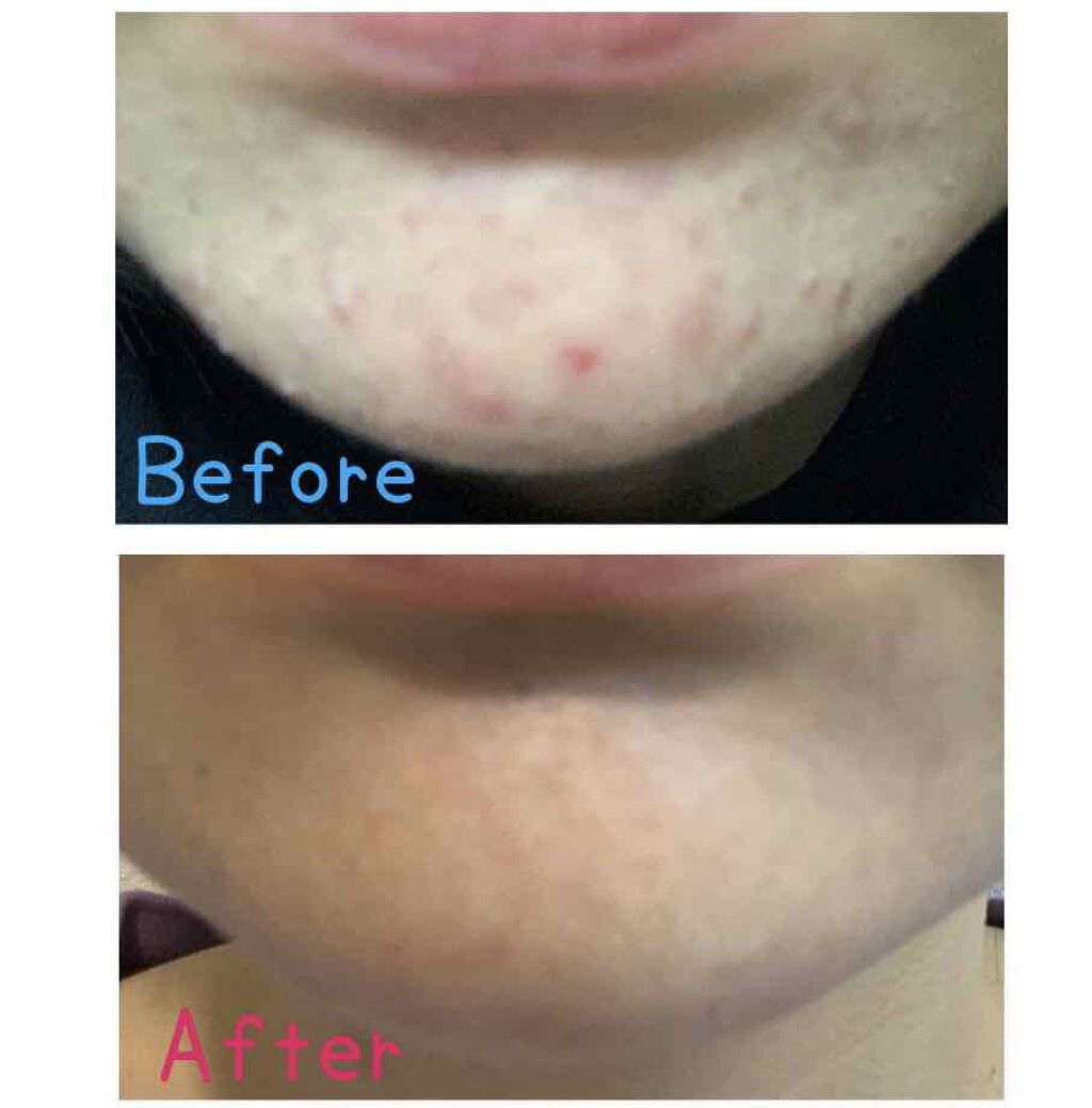 モイストバランス ローション/ACSEINE/化粧水を使ったクチコミ(3枚目)