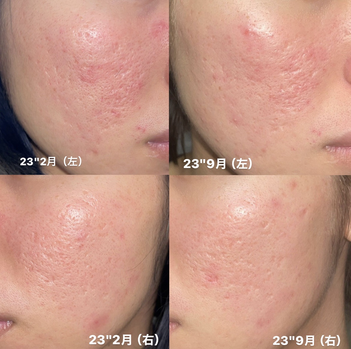 ダーマペン・ダーマスタンプ/MyM/その他スキンケアグッズを使ったクチコミ（1枚目）