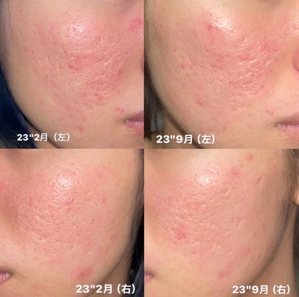 ダーマペン・ダーマスタンプ/MyM/その他スキンケアグッズを使ったクチコミ(1枚目)