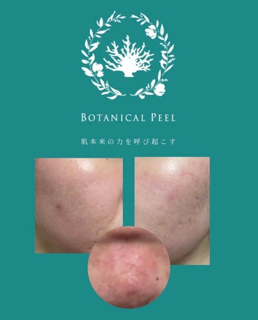 ボタニカルピーリングパウダー＆ベースジェルLevel1/BOTANICAL PEEL/ピーリングを使ったクチコミ（2枚目）