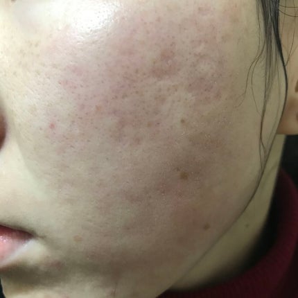 ティーツリーケア ソリューション エッセンシャルマスクEX/MEDIHEAL/シートマスク・パックを使ったクチコミ(2枚目)