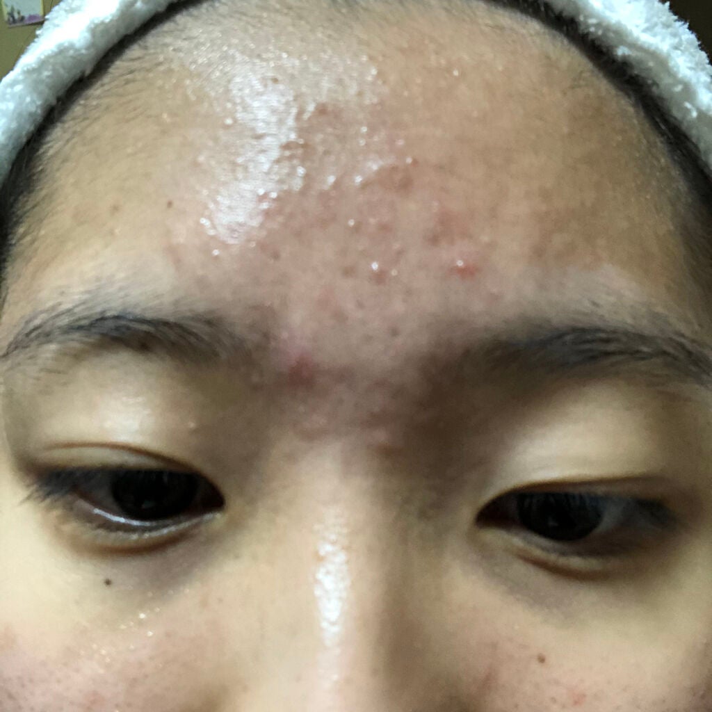 肌荒れとおさらば on LIPS 「19日目です💚💚なんと私肌荒れとおさらば、、皮膚科に行ってまい..」(3枚目)