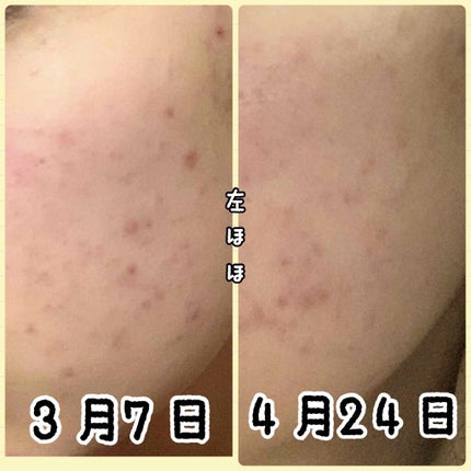白潤 薬用美白化粧水(しっとりタイプ)/肌ラボ/化粧水を使ったクチコミ(3枚目)