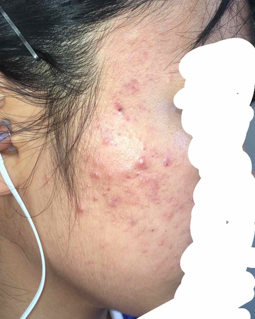 薬用 しみ 集中対策 美容液/メラノCC/美容液を使ったクチコミ(2枚目)