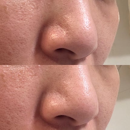 アンチポアブラックヘッドパーフェクトクリアキット/CNP Laboratory/シートマスク・パックを使ったクチコミ(4枚目)