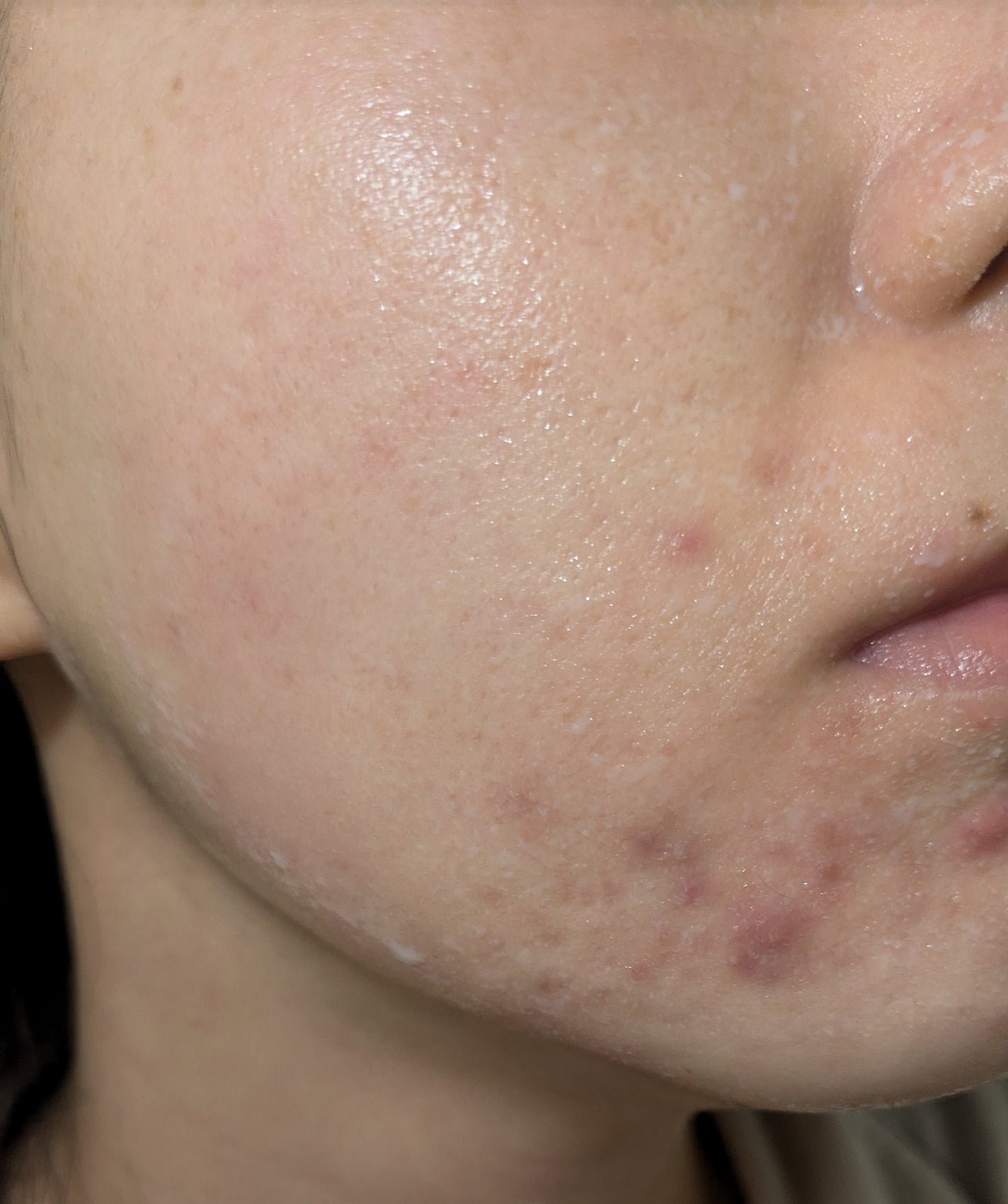 miina@汚肌工事録⚠️ on LIPS 「11/18の#汚肌工事録😂..」(1枚目)