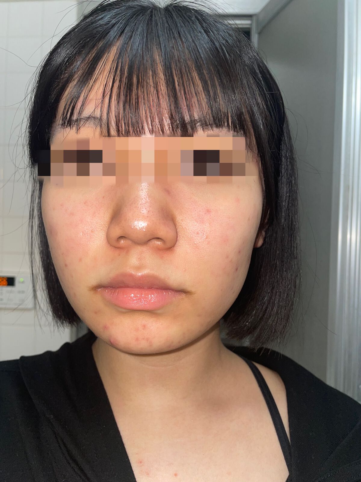 ペアアクネクリームW(医薬品)/ペア/その他を使ったクチコミ（2枚目）