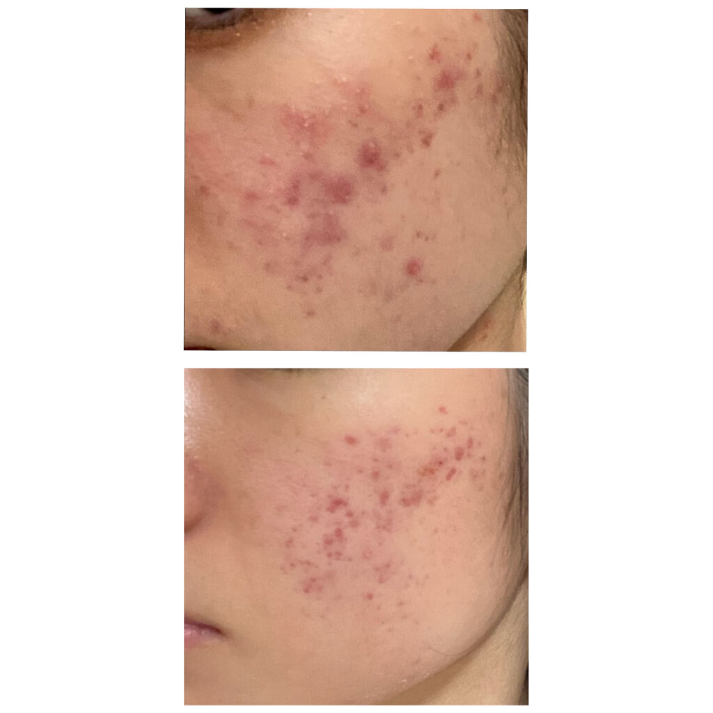 クリンダマイシンゲル(医薬品)/クラシエ薬品/その他を使ったクチコミ（3枚目）