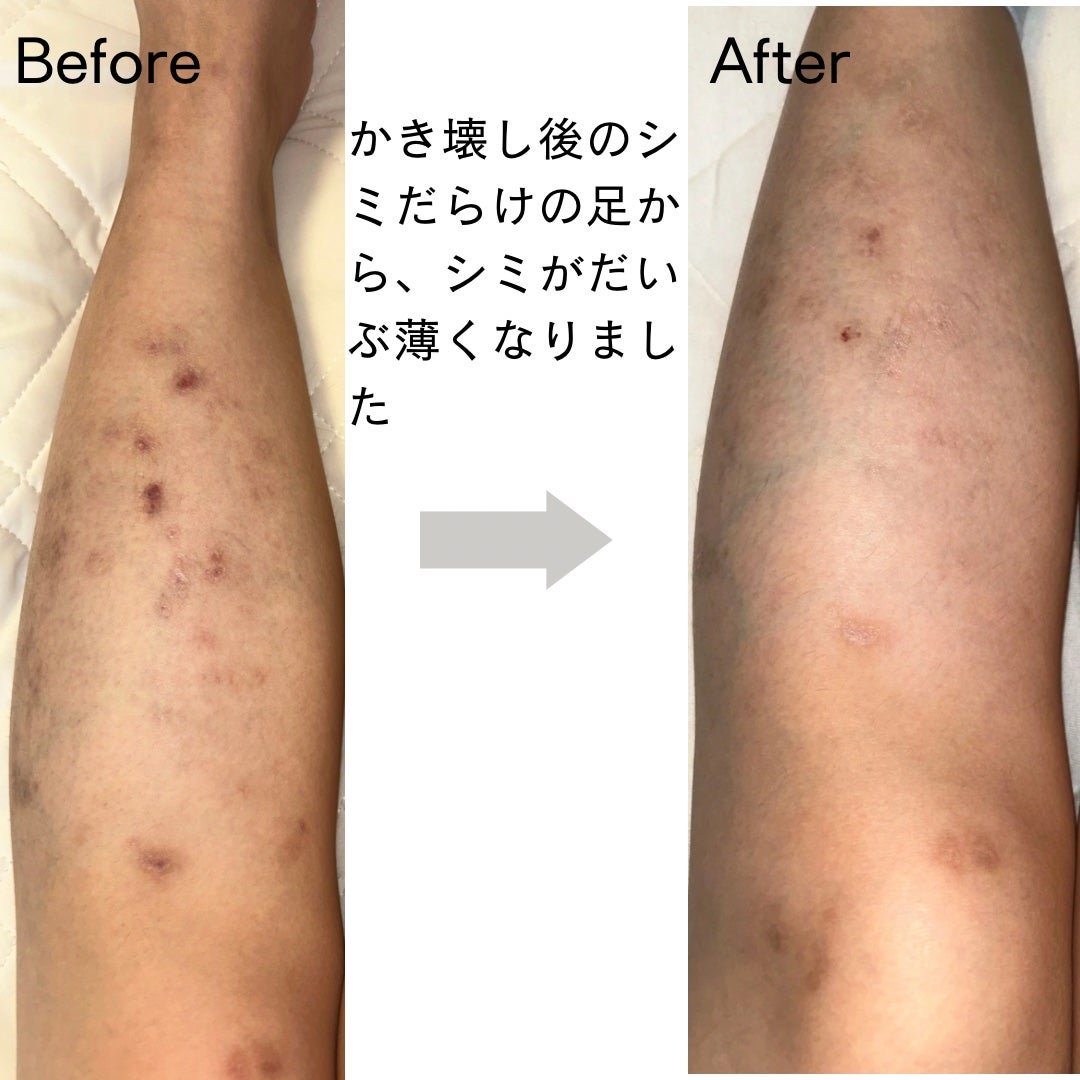 薬用 しみ 集中対策 美容液/メラノCC/美容液を使ったクチコミ(4枚目)