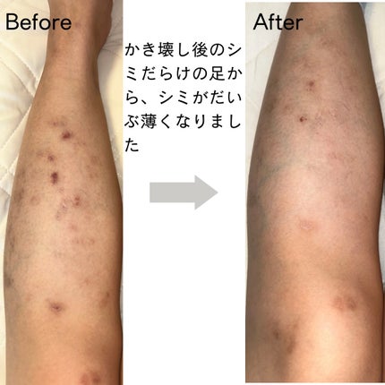 薬用 しみ 集中対策 美容液/メラノCC/美容液を使ったクチコミ(4枚目)