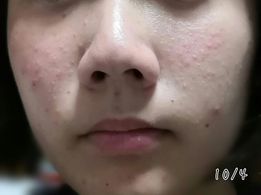 薬用 しみ 集中対策 美容液/メラノCC/美容液を使ったクチコミ(3枚目)