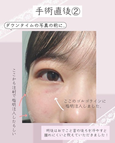 ぴーちゃん🧡 on LIPS 「クマ取り体験談/┈┈┈┈┈┈┈┈┈┈ストーリーズにダウンタイム..」（6枚目）