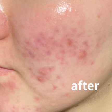 きちぽん on LIPS 「汚肌失礼しました。元々ニキビ肌だったのですが、自粛になった去年..」(5枚目)