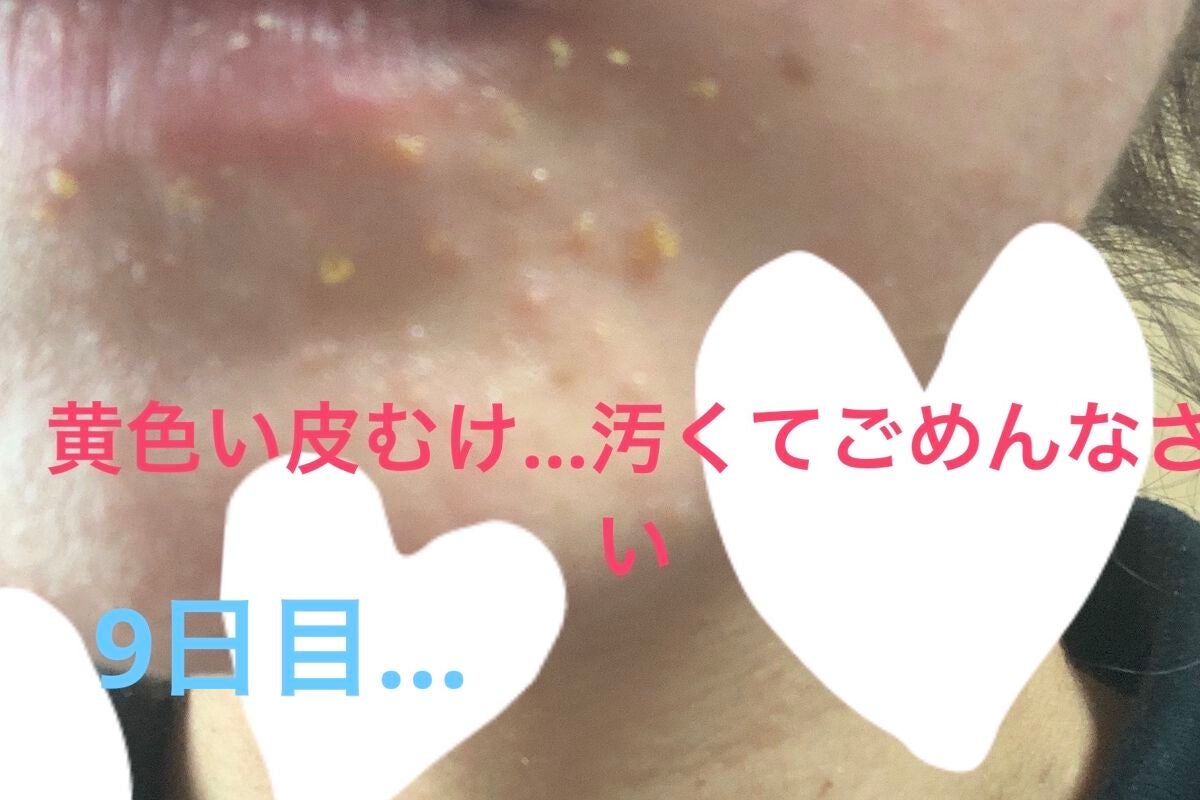 ルルルンピュア エブリーズ/ルルルン/シートマスク・パックを使ったクチコミ(4枚目)