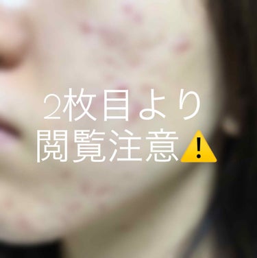 メラノCC 薬用 しみ 集中対策 美容液のクチコミ「⚠️お目汚し失礼します😣😣
ご協力ください💦

頬ニキビ(左のみ)(ニキビ跡、クレーター含む).....」（1枚目）