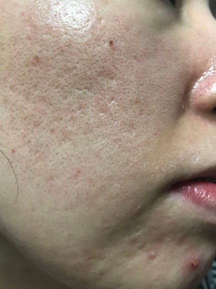 メディカルクリームc(医薬品)/メンソレータム アクネス25/その他を使ったクチコミ(1枚目)