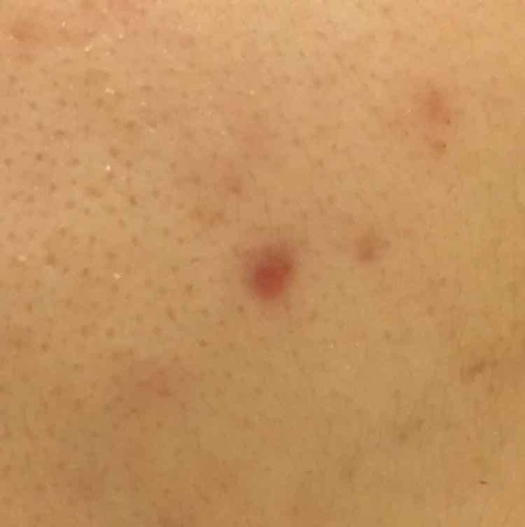 薬用 しみ 集中対策 美容液/メラノCC/美容液を使ったクチコミ(2枚目)