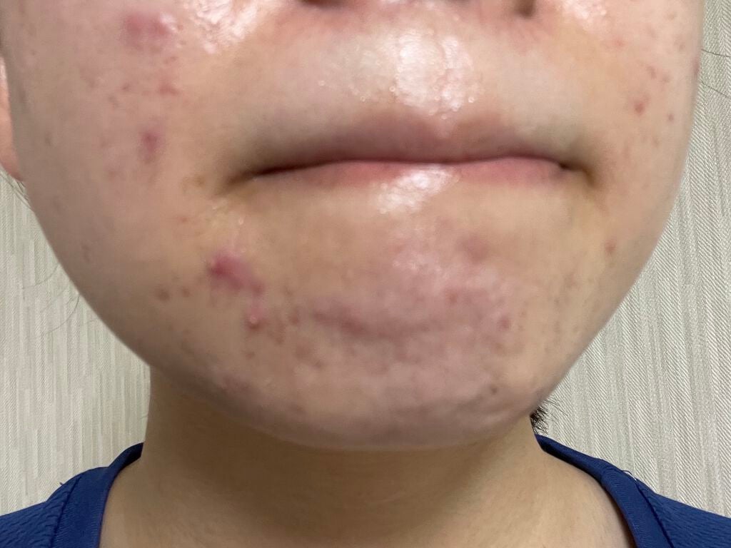 まままこ on LIPS 「ニキビゼロ肌を目指して〜1日目〜⚠️2枚目から肌画像ありスキン..」(4枚目)