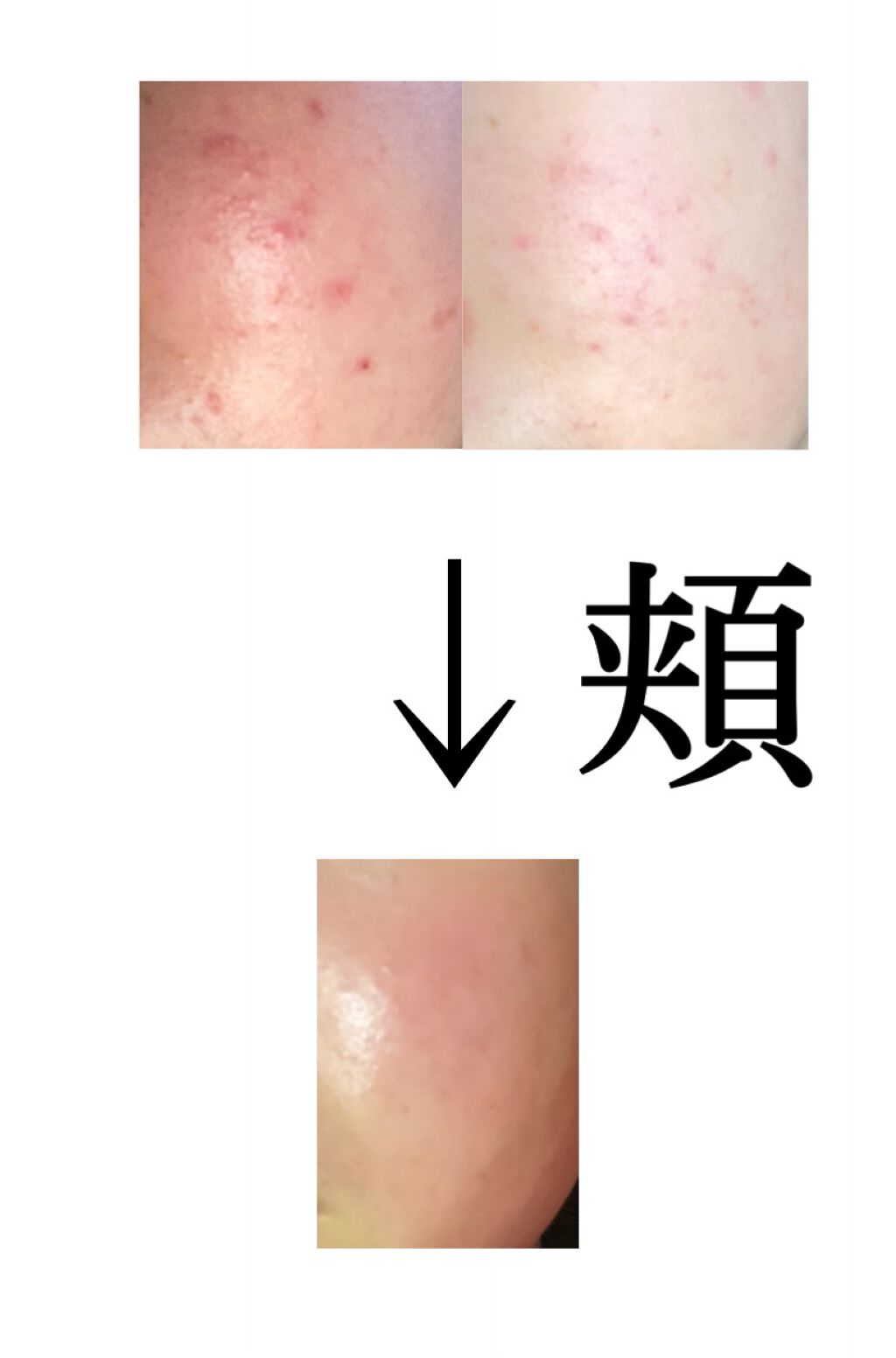 A アクネフォーム/NOV/洗顔フォームを使ったクチコミ(3枚目)