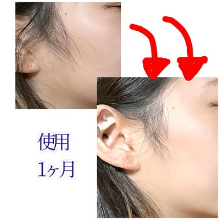 スキンピールバー ティートゥリー/サンソリット/洗顔石鹸を使ったクチコミ(7枚目)