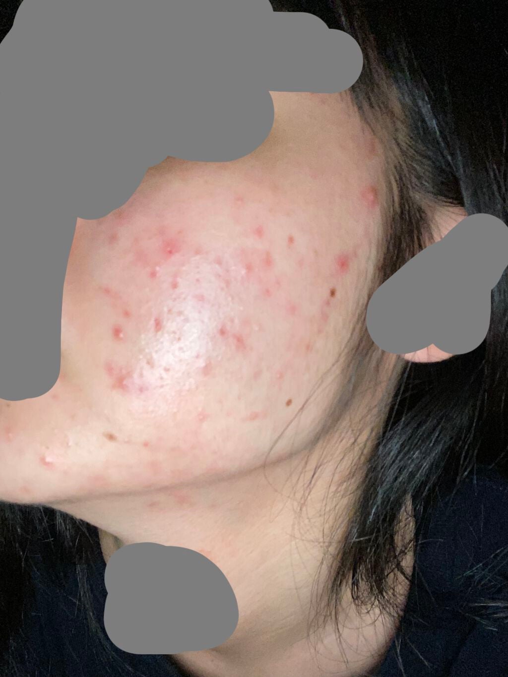 あちもち on LIPS 「⚠️助けてください⚠️ニキビ日記2日目━━━━━━━━━━━━..」(1枚目)